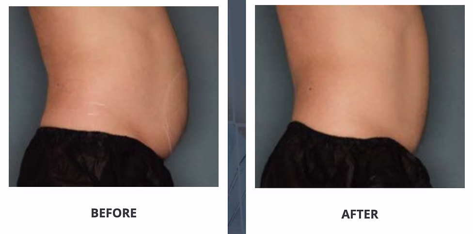 ultra_shape_before_after